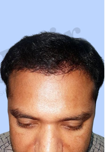 After — Hair transplant patient result 17 at DR HAIR® India, Jaipur