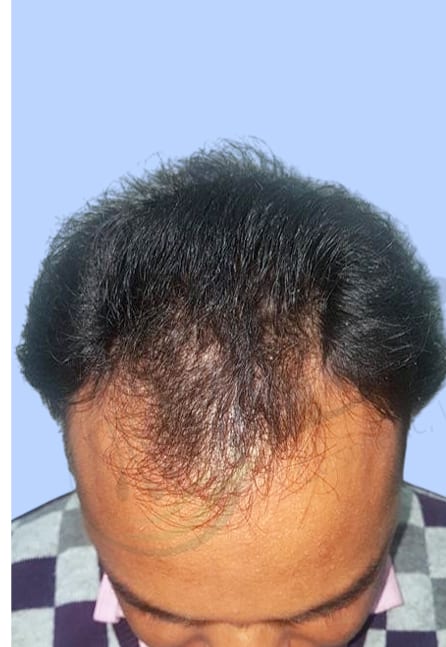 Before — Hair transplant patient result 17 at DR HAIR® India, Jaipur