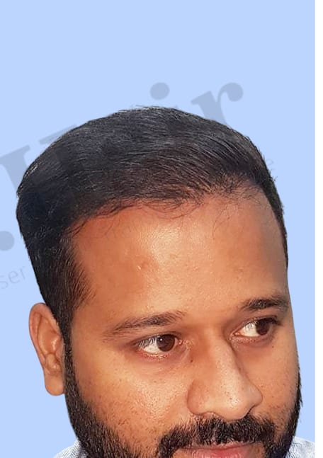 After — Hair transplant patient result 18 at DR HAIR® India, Jaipur
