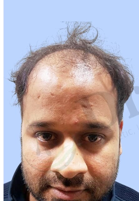 Before — Hair transplant patient result 18 at DR HAIR® India, Jaipur