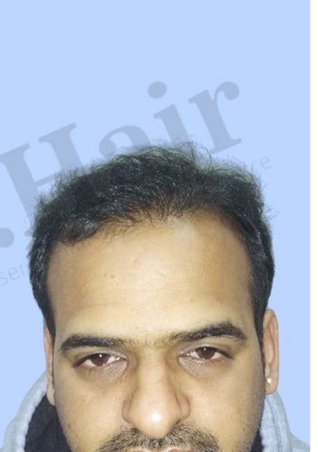 After — Hair transplant patient result 19 at DR HAIR® India, Jaipur