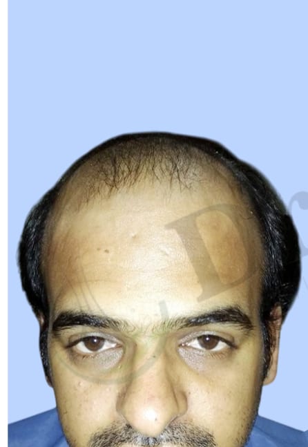 Before — Hair transplant patient result 19 at DR HAIR® India, Jaipur