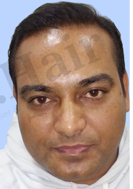 After — Hair transplant patient result 2 at DR HAIR® India, Jaipur