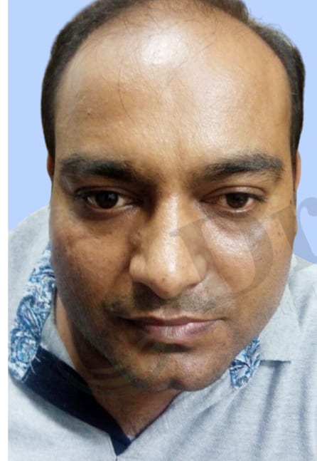 Before — Hair transplant patient result 2 at DR HAIR® India, Jaipur
