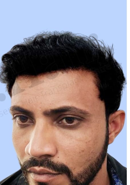 After — Hair transplant patient result 20 at DR HAIR® India, Jaipur