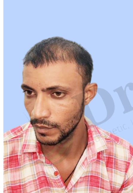 Before — Hair transplant patient result 20 at DR HAIR® India, Jaipur
