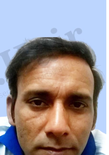 After — Hair transplant patient result 21 at DR HAIR® India, Jaipur