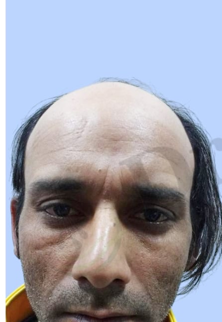 Before — Hair transplant patient result 21 at DR HAIR® India, Jaipur