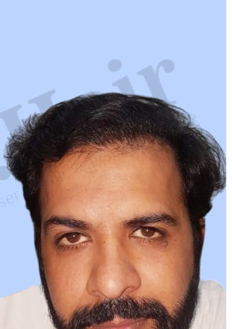 After — Hair transplant patient result 22 at DR HAIR® India, Jaipur