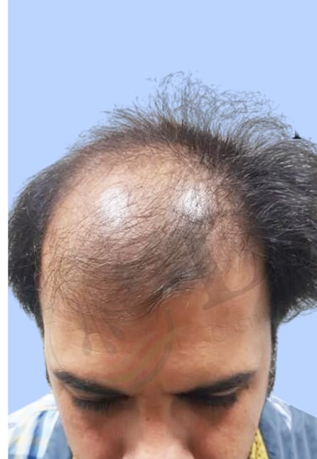 Before — Hair transplant patient result 22 at DR HAIR® India, Jaipur