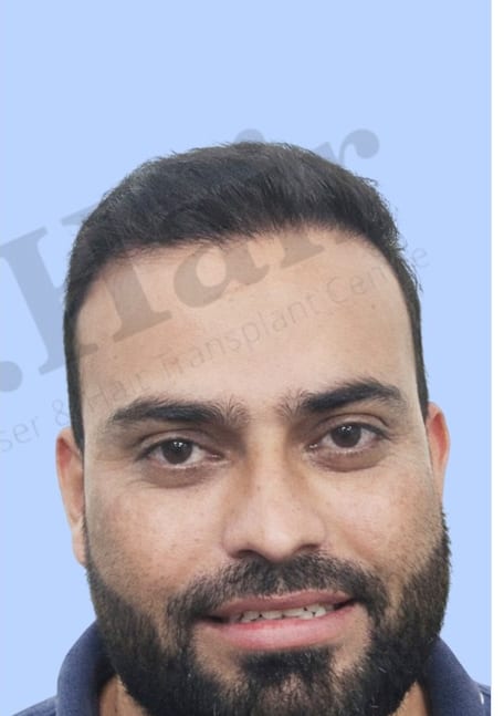 After — Hair transplant patient result 23 at DR HAIR® India, Jaipur
