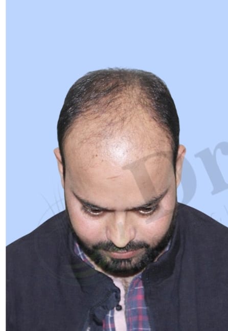 Before — Hair transplant patient result 23 at DR HAIR® India, Jaipur