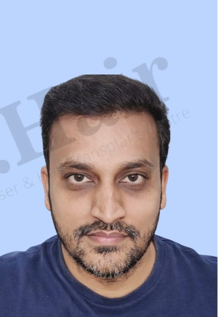 After — Hair transplant patient result 24 at DR HAIR® India, Jaipur
