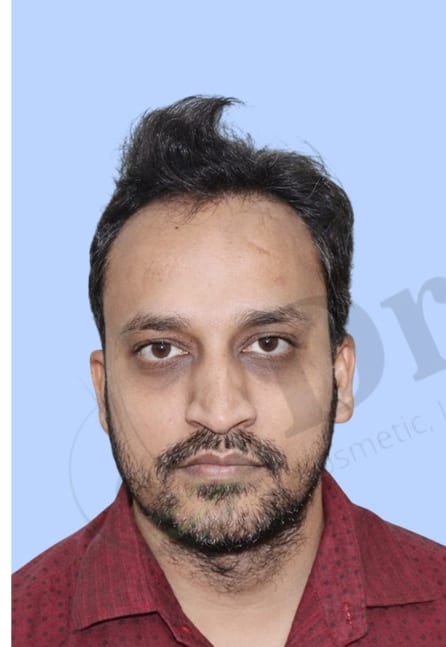 Before — Hair transplant patient result 24 at DR HAIR® India, Jaipur