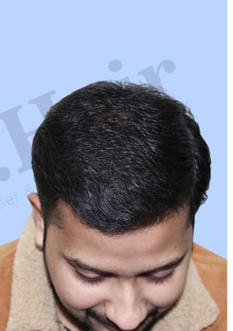 After — Hair transplant patient result 25 at DR HAIR® India, Jaipur