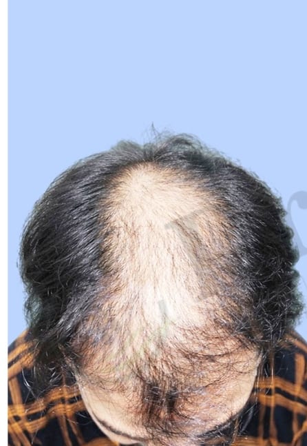 Before — Hair transplant patient result 25 at DR HAIR® India, Jaipur