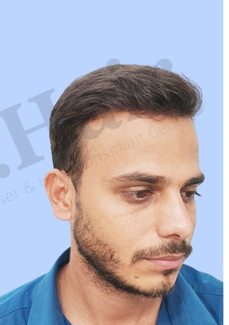 After — Hair transplant patient result 26 at DR HAIR® India, Jaipur