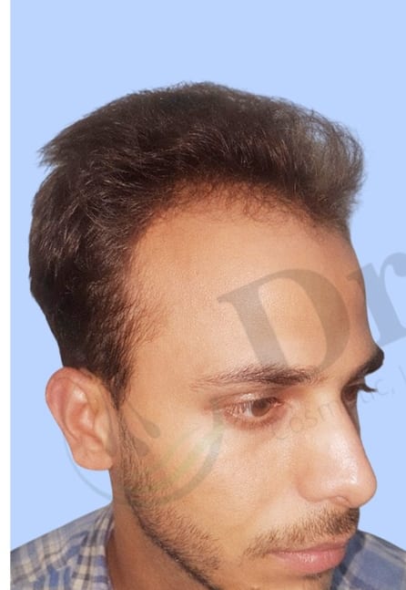 Before — Hair transplant patient result 26 at DR HAIR® India, Jaipur