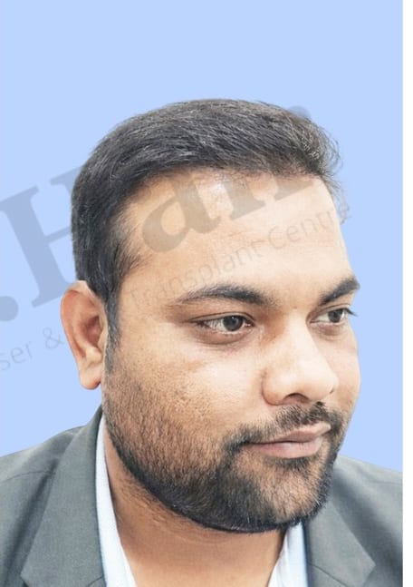 After — Hair transplant patient result 27 at DR HAIR® India, Jaipur