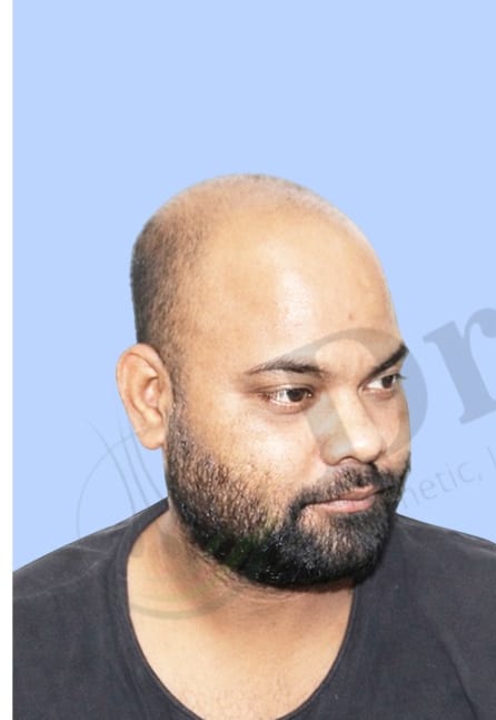 Before — Hair transplant patient result 27 at DR HAIR® India, Jaipur