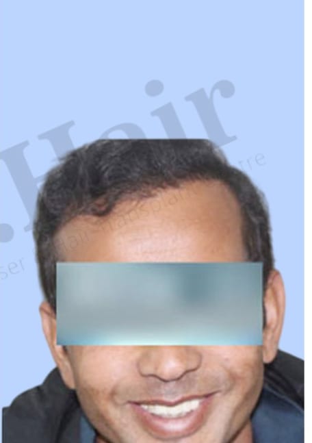 After — Hair transplant patient result 28 at DR HAIR® India, Jaipur