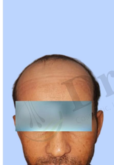Before — Hair transplant patient result 28 at DR HAIR® India, Jaipur