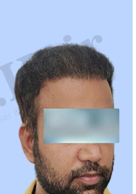 After — Hair transplant patient result 29 at DR HAIR® India, Jaipur
