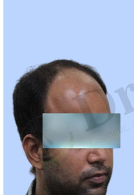 Before — Hair transplant patient result 29 at DR HAIR® India, Jaipur