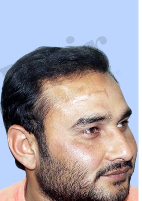 After — Hair transplant patient result 3 at DR HAIR® India, Jaipur