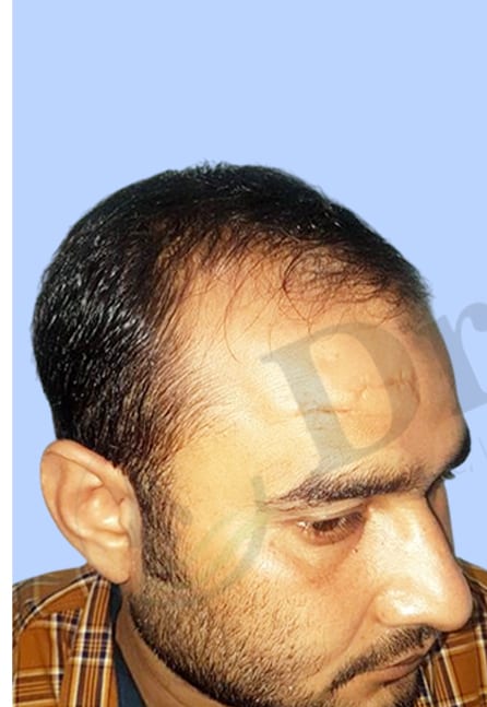 Before — Hair transplant patient result 3 at DR HAIR® India, Jaipur