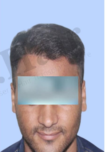 After — Hair transplant patient result 30 at DR HAIR® India, Jaipur
