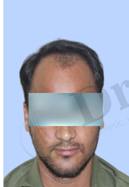 Before — Hair transplant patient result 30 at DR HAIR® India, Jaipur