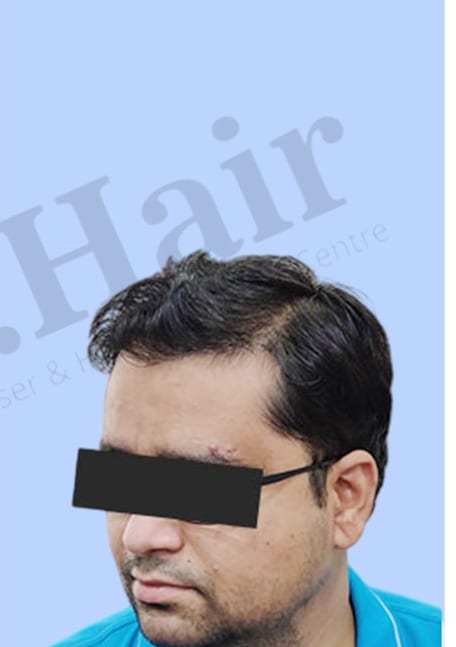 After — Hair transplant patient result 31 at DR HAIR® India, Jaipur