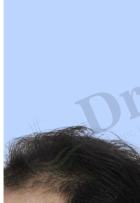 Before — Hair transplant patient result 31 at DR HAIR® India, Jaipur