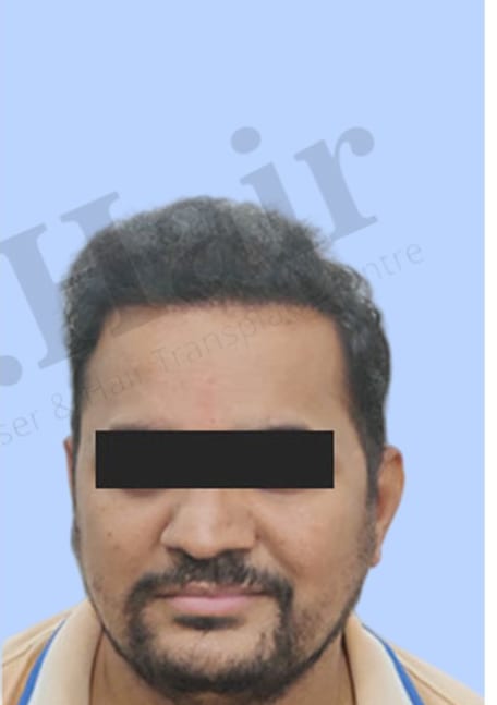 After — Hair transplant patient result 32 at DR HAIR® India, Jaipur