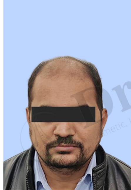 Before — Hair transplant patient result 32 at DR HAIR® India, Jaipur