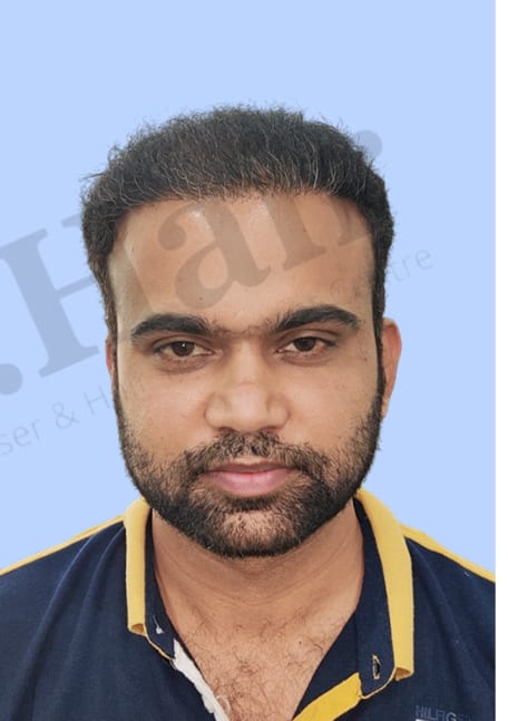 After — Hair transplant patient result 33 at DR HAIR® India, Jaipur