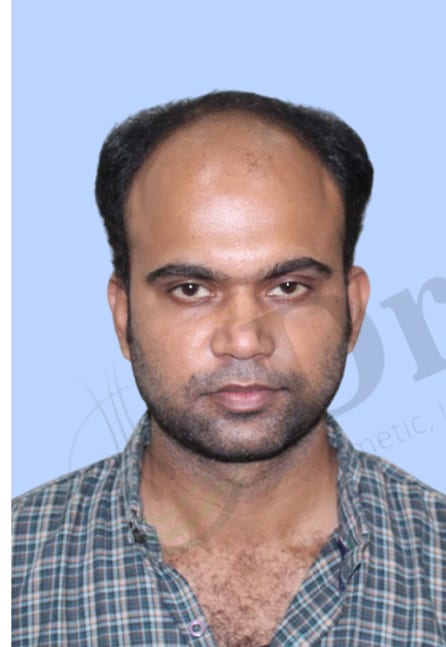 Before — Hair transplant patient result 33 at DR HAIR® India, Jaipur