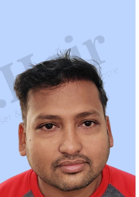 After — Hair transplant patient result 34 at DR HAIR® India, Jaipur