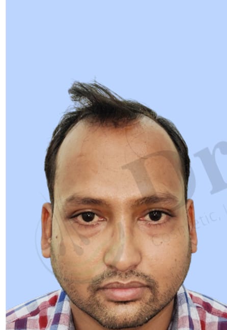 Before — Hair transplant patient result 34 at DR HAIR® India, Jaipur