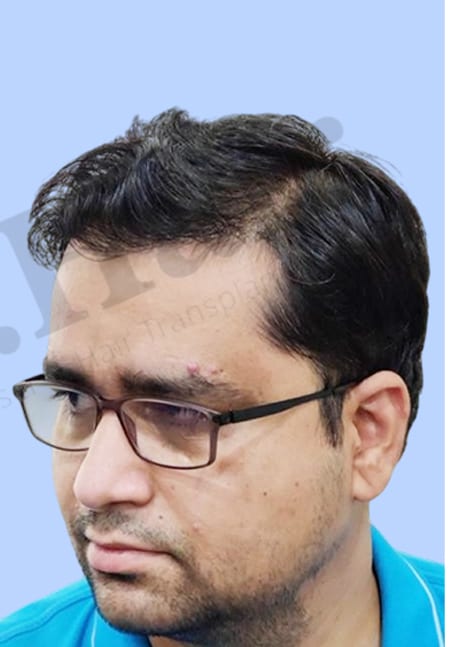 After — Hair transplant patient result 4 at DR HAIR® India, Jaipur
