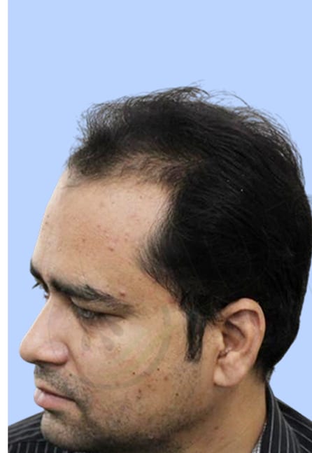 Before — Hair transplant patient result 4 at DR HAIR® India, Jaipur