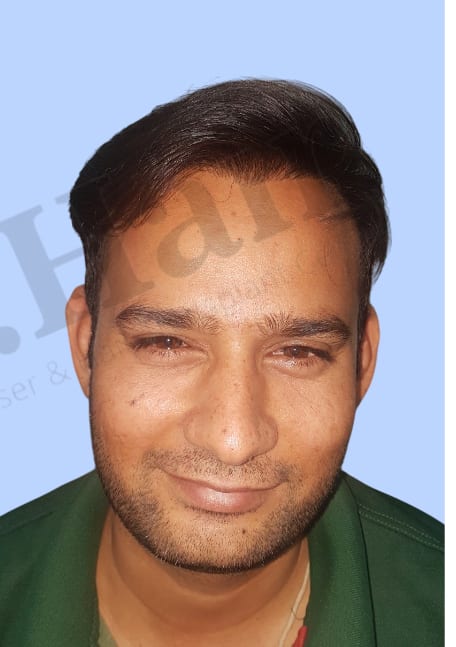 After — Hair transplant patient result 35 at DR HAIR® India, Jaipur