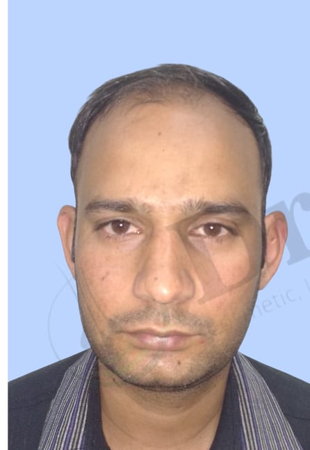 Before — Hair transplant patient result 35 at DR HAIR® India, Jaipur