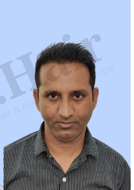 After — Hair transplant patient result 36 at DR HAIR® India, Jaipur