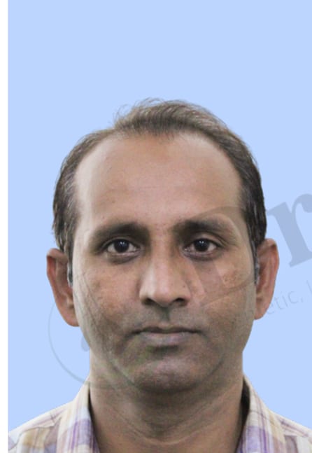 Before — Hair transplant patient result 36 at DR HAIR® India, Jaipur