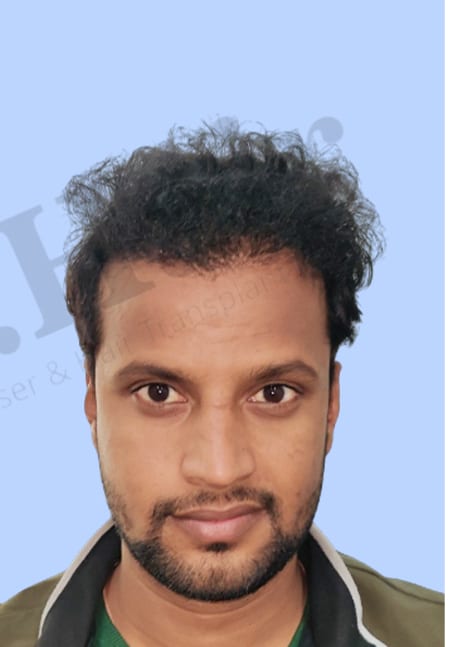 After — Hair transplant patient result 37 at DR HAIR® India, Jaipur