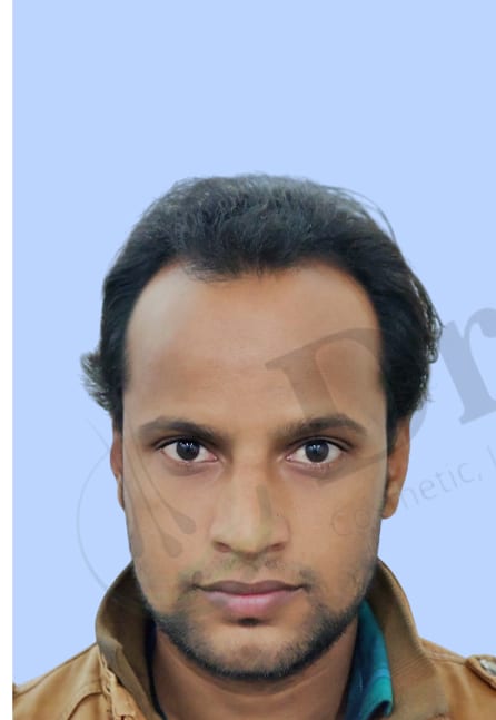 Before — Hair transplant patient result 37 at DR HAIR® India, Jaipur