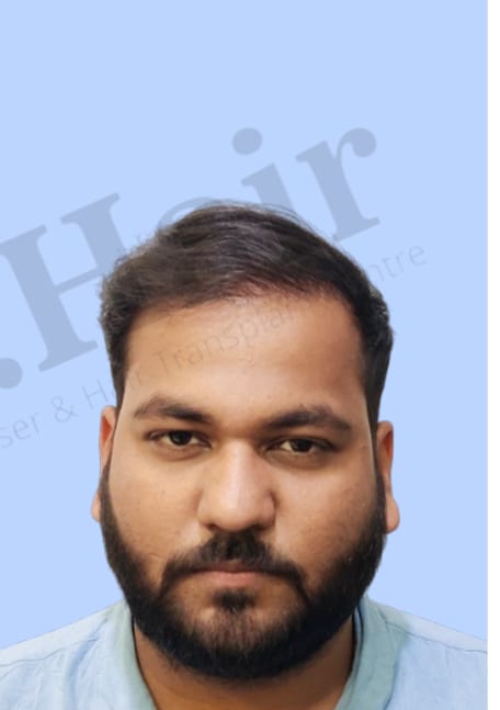 After — Hair transplant patient result 38 at DR HAIR® India, Jaipur