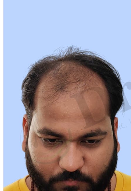 Before — Hair transplant patient result 38 at DR HAIR® India, Jaipur
